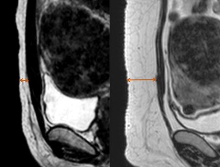 MRI-fat-하이푸효과.jpg