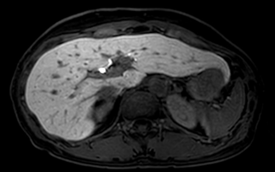 3T MRI 간암 프리모비스트 검사_민트병원.JPG