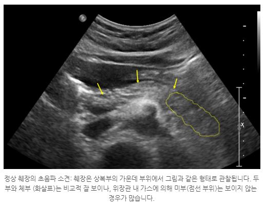 췌장암초음파검사영상.JPG