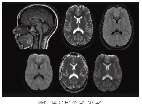 뇌MRI_민트병원.jpg