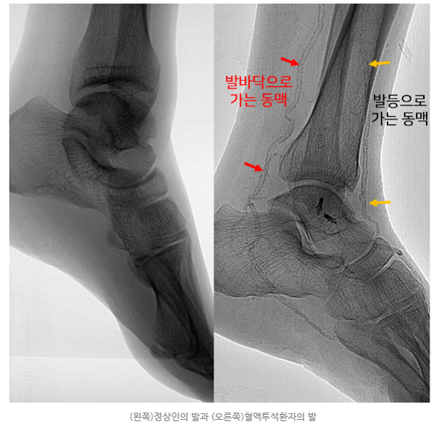 문정동 민트병원_혈액투석환자의 발 저림_배재익 원장1.png